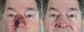 Skin Cancer Treatment Patient 31