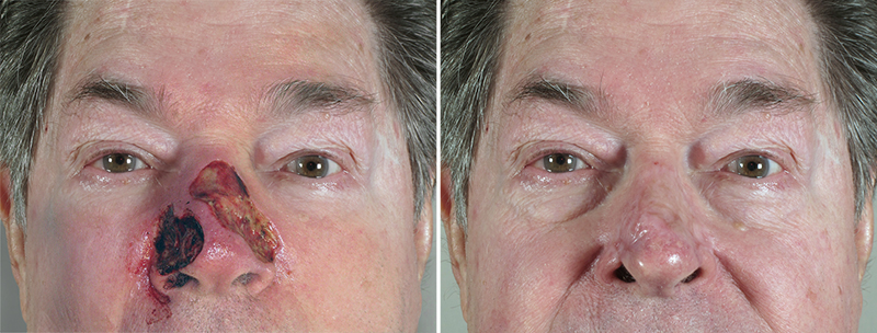 Skin Cancer Treatment Patient 31