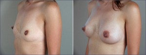 breast augmentation new jersey breast augmentation new jersey