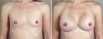 Breast Enlargement (Augmentation) Patient 51