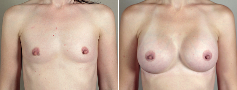 Breast Enlargement (Augmentation) Patient 51