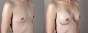 Breast Enlargement (Augmentation) Patient 51