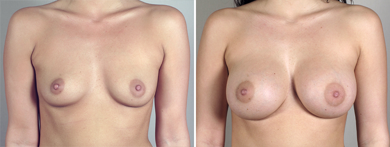 Breast Enlargement (Augmentation) Patient 52