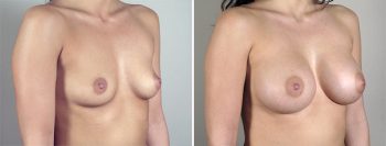 Breast Enlargement (Augmentation) Patient 52