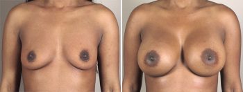 Breast Enlargement (Augmentation) Patient 53
