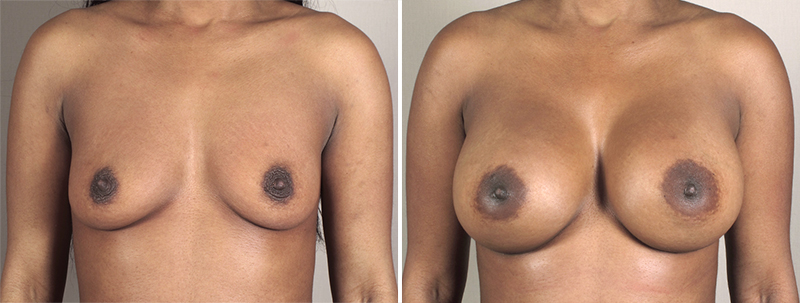 Breast Enlargement (Augmentation) Patient 53