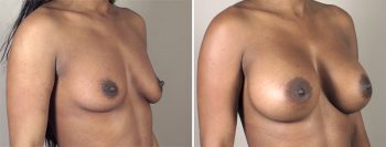 Breast Enlargement (Augmentation) Patient 53