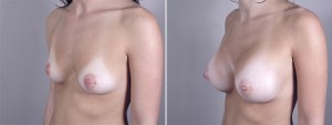 breast_enlargement_35b