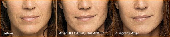 Belotero New Jersey Image