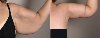 Upper Arm Rejuvenation Patient 8 – Arm Lift