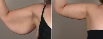 Upper Arm Rejuvenation Patient 8 – Arm Lift