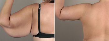 Upper Arm Rejuvenation Patient 8 – Arm Lift