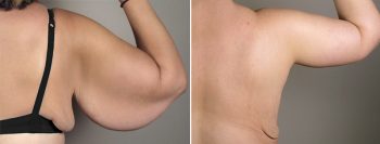 Upper Arm Rejuvenation Patient 8 – Arm Lift