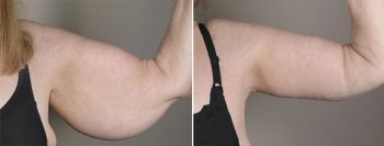 Upper Arm Rejuvenation Patient 9 – Arm Lift