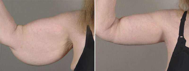Upper Arm Rejuvenation Patient 9 – Arm Lift