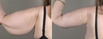 Upper Arm Rejuvenation Patient 9 – Arm Lift