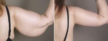 Upper Arm Rejuvenation Patient 9 – Arm Lift