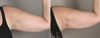 Upper Arm Rejuvenation Patient 10 – Mini Arm Lift
