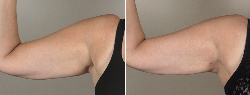 Upper Arm Rejuvenation Patient 10 – Mini Arm Lift