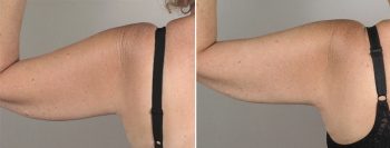 Upper Arm Rejuvenation Patient 10 – Mini Arm Lift