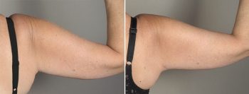 Upper Arm Rejuvenation Patient 10 – Mini Arm Lift