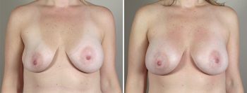 Removal & Replacement of Implants Patient 19