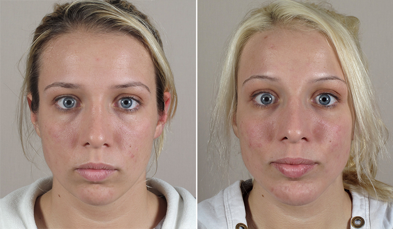 Neck Liposuction & Chin Implant Patient 11