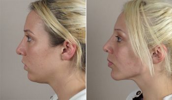 Neck Liposuction & Chin Implant Patient 11