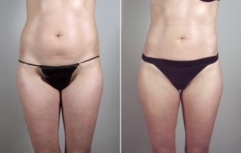 Liposuction Patient 37