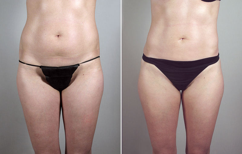 Liposuction Patient 37