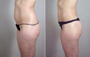 Liposuction Patient 37