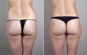 Liposuction Patient 37