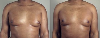 Gynecomastia Reduction Patient 31