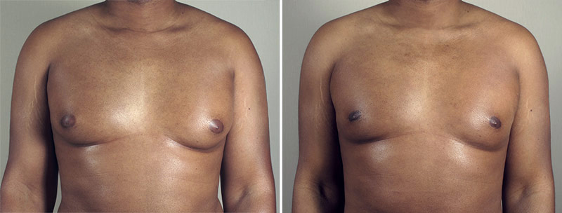 Before & after gynecomastia Breast Reduction for Men New Jersey Photo