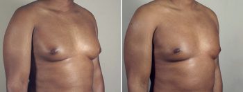 Gynecomastia Reduction Patient 31