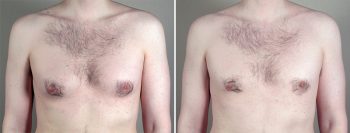 Gynecomastia Reduction Patient 32