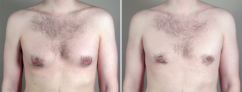 Gynecomastia Reduction Patient 32