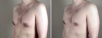 Gynecomastia Reduction Patient 32