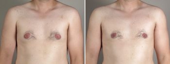 Gynecomastia Reduction Patient 33