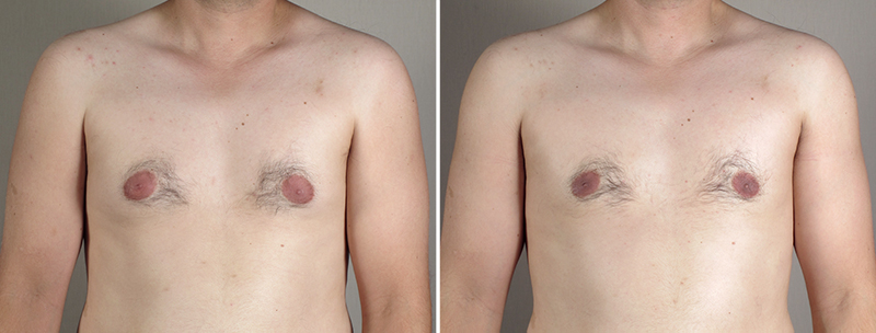 Gynecomastia Reduction Patient 33