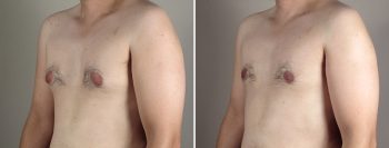 Gynecomastia Reduction Patient 33