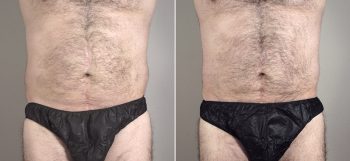 Male Liposuction Patient 19
