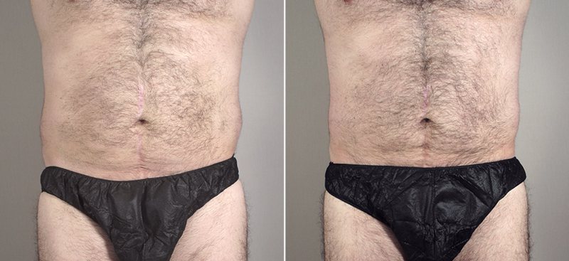 Male Liposuction Patient 19
