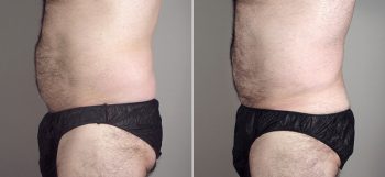 Male Liposuction Patient 19