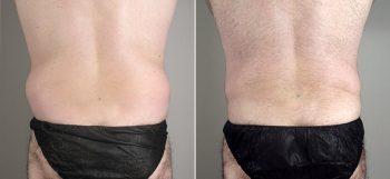 Male Liposuction Patient 19