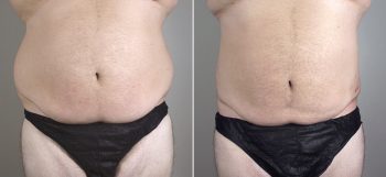 Male Liposuction Patient 20