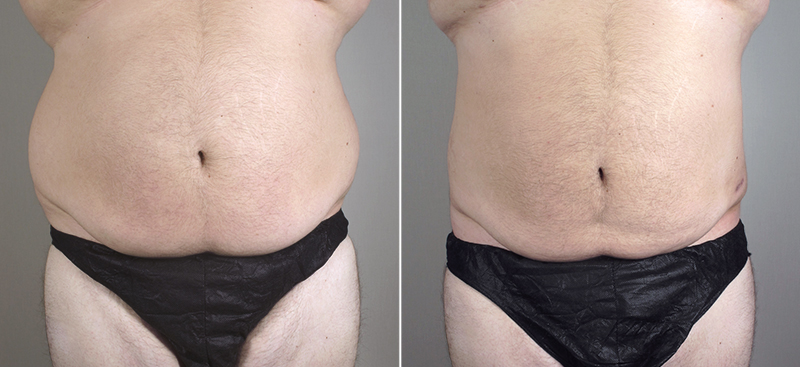 Male Liposuction Patient 20