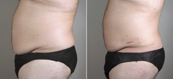 Male Liposuction Patient 20