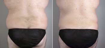 Male Liposuction Patient 20