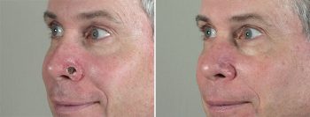 Skin Cancer Treatment Patient 32